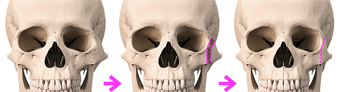 頬骨弓骨切り移動術2