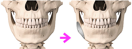 下顎角形成術 / 外板切除術
