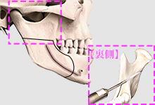 下顎枝内側の骨皮質だけを水平に骨切り