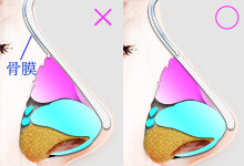 骨膜（鼻骨を覆う被膜）と鼻骨の間に挿入