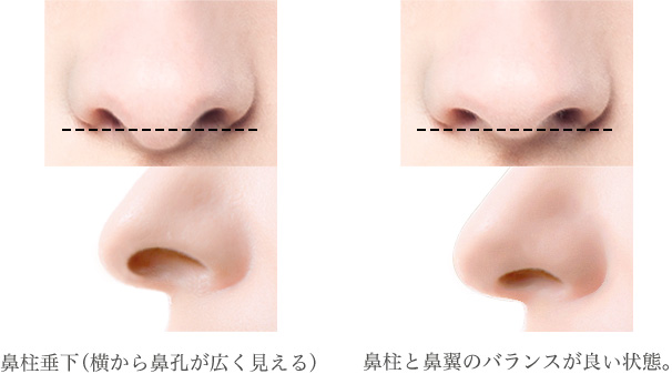 鼻柱と鼻翼のバランスや横顔からの評価を計算した自然な鼻柱の形成