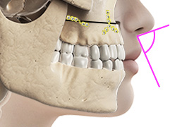 Lefort-1型骨切りで上顎全体を前方に移動