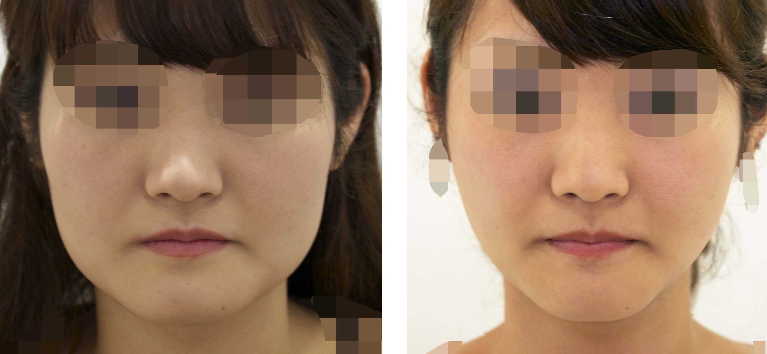 顔幅縮小〜中顔面幅縮小と頬のたるみ〜 | マックスファクス銀座