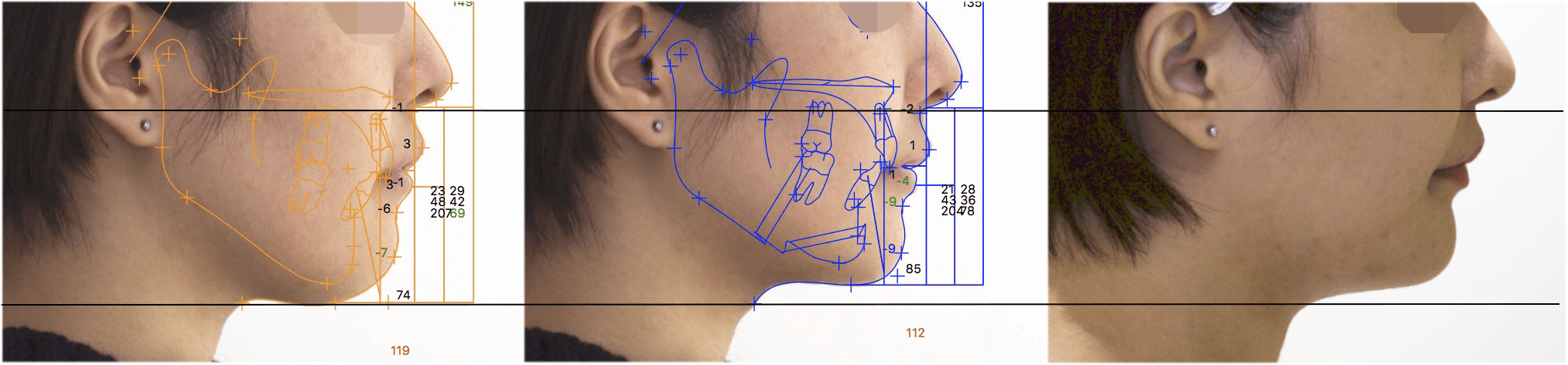 両顎手術シミュレーションの再現性 | マックスファクス銀座クリニック