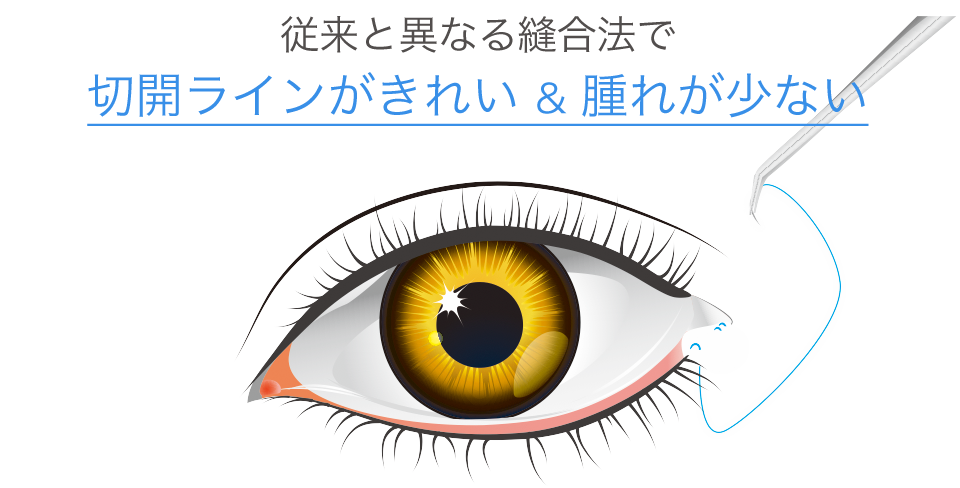 従来と異なる縫合法で切開ラインがキレイ＆腫れが少ない