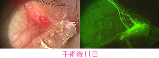 手術後11日