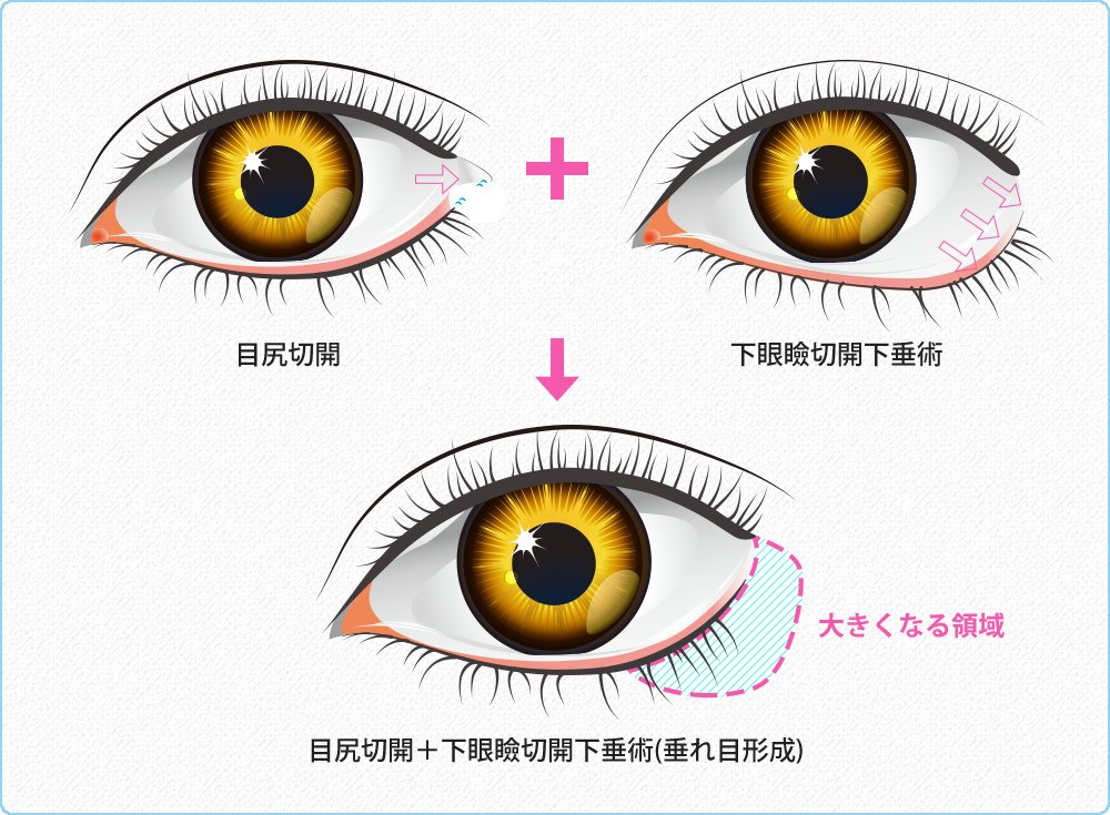 目尻側をより大きく見せたい場合 図