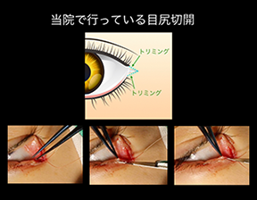 当院で行っている目尻切開