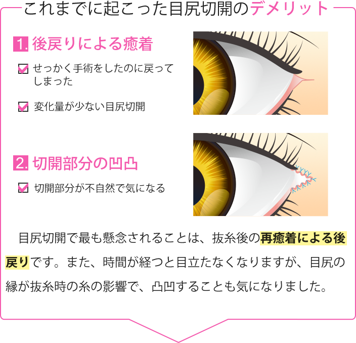 これまでに起こった目尻切開のデメリット。１）後戻りによる癒着　２）切開部分の凹凸　３）目尻切開の懸念