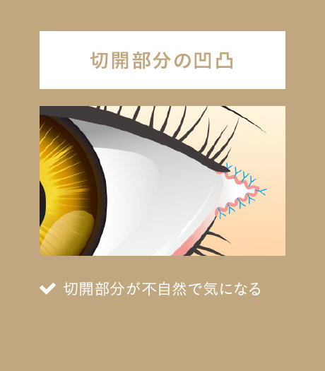 後戻りの少ない目尻切開術 | マックスファクス銀座クリニック