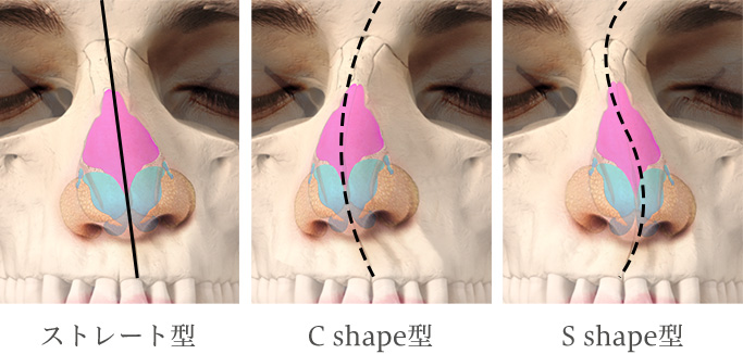 鼻 の 曲がり 矯正