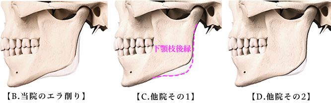 エラ 削り 費用