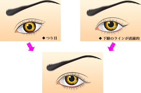 垂れ目形成の施術の特徴