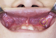 口腔粘膜を5mm程度切開