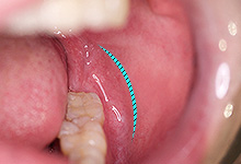 大臼歯外側の頬粘膜に5㎝程度切開
