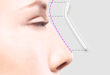 眉間を高くする施術 診療案内 マックスファクス銀座クリニック